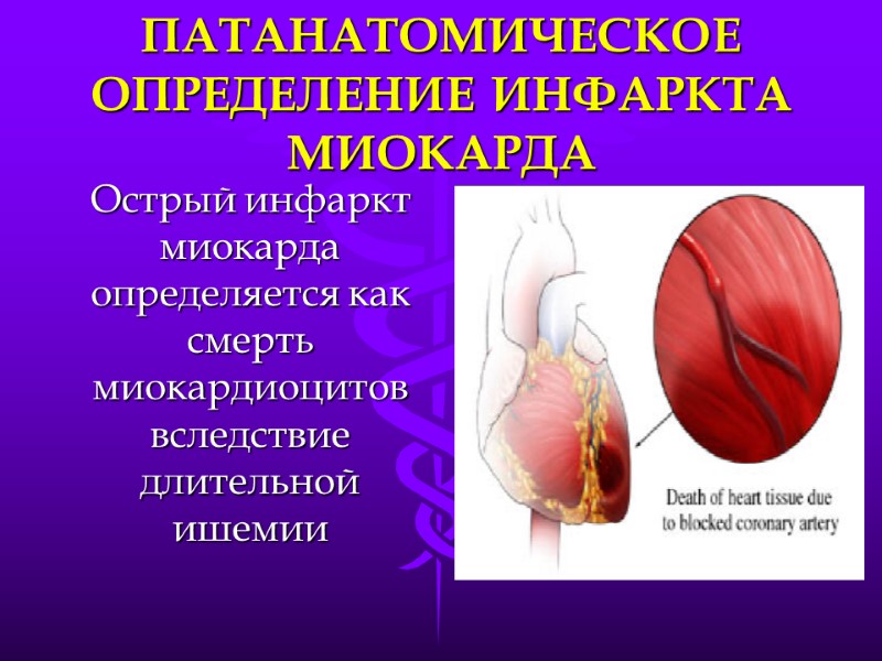 ПАТАНАТОМИЧЕСКОЕ ОПРЕДЕЛЕНИЕ ИНФАРКТА МИОКАРДА Острый инфаркт миокарда определяется как смерть миокардиоцитов вследствие длительной ишемии